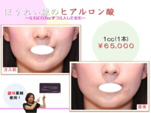 注入療法の症例写真