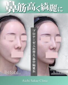 プロテーゼ入れ替え＋鼻中隔延長