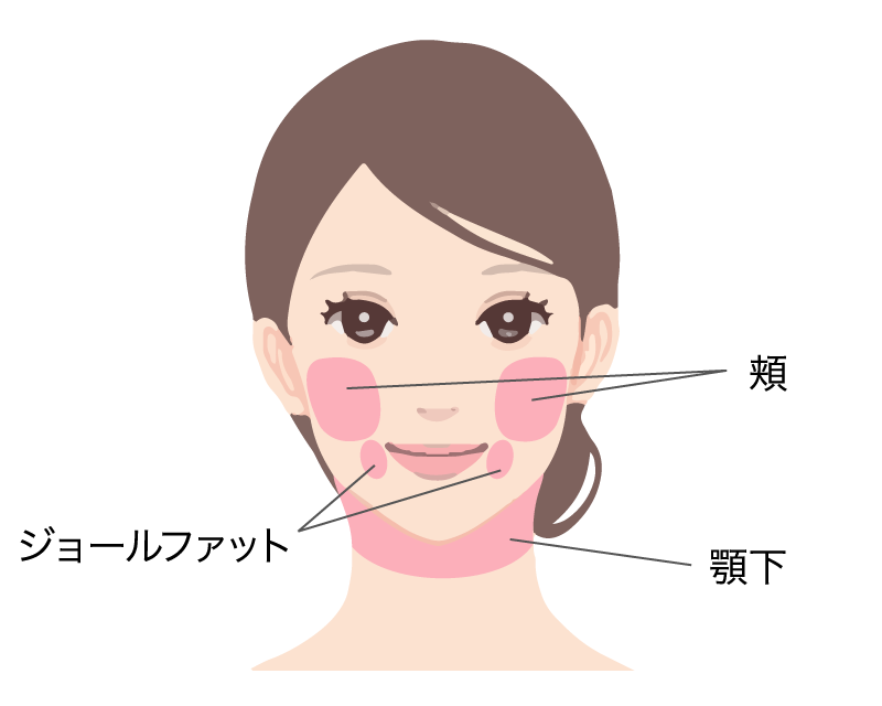 頬、ジョールファット、顎下のベイザー脂肪吸引の施術部位を示した女性の顔イラスト