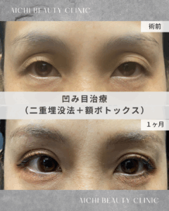 凹み目治療（二重埋没２点法＋額ボトックス）/ 吉田Dr.