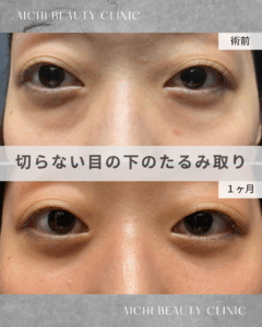 20代女性　目の下の切らないたるみ取り（経結膜脱脂術）/ 吉田Dr.