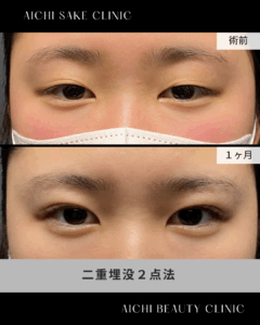 10代女性　二重埋没２点法 / 吉田Dr.