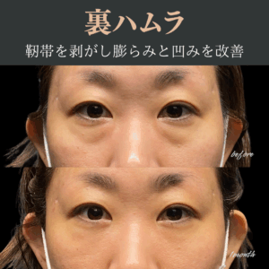 裏ハムラ法（経結膜眼窩脂肪移動術）　30代　女性 / 吉田Dr.