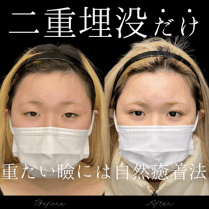 自然癒着法　20代　女性　/ 吉田Dr.