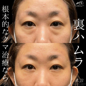 裏ハムラ法（経結膜眼窩脂肪移動術）　30代　女性　/吉田Dr