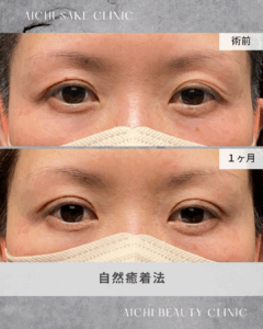 40歳女性　自然癒着法 / 吉田Dr.