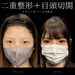 自然癒着法＋目頭切開(Z形成）　20代　女性　/ 吉田Dr.