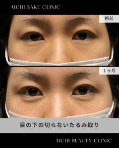 30代女性　目の下の切らないたるみ取り（経結膜脱脂術）/ 吉田Dr.