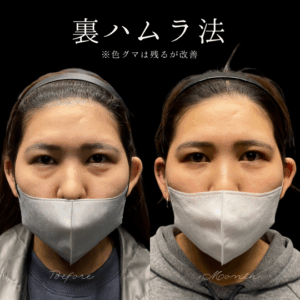 裏ハムラ法（経結膜眼窩脂肪移動術）　20代　女性　/吉田Dr