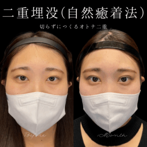 自然癒着法　20代　女性　/ 吉田Dr.