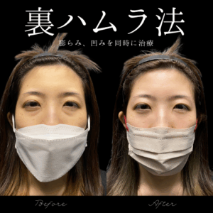 裏ハムラ法（経結膜眼窩脂肪移動術）　30代　女性　/吉田Dr