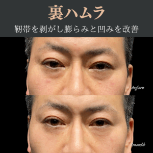 裏ハムラ法（経結膜眼窩脂肪移動術）　40代　男性　/ 吉田Dr.