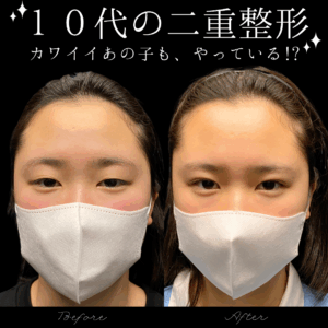 二重埋没２点法　10代　女性／吉田Dr.