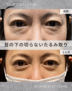 50代女性　目の下の切らないたるみ取り（経結膜脱脂術）/ 吉田Dr.