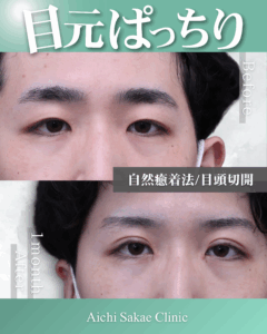 ２０代　自然癒着法＋目頭切開(執刀医横山医師)