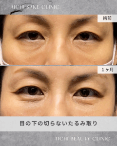 50代女性　目の下の切らないたるみ取り（経結膜脱脂術）/ 吉田Dr.