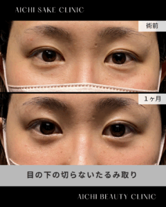 30代女性　目の下の切らないたるみ取り（経結膜脱脂術）/ 吉田Dr.