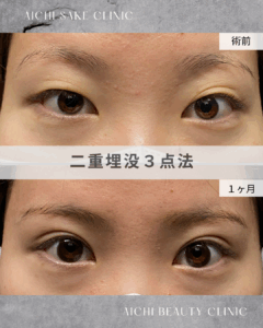 20代女性　二重埋没3点法 / 吉田Dr.
