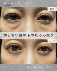 40代女性　目の下の切らないたるみ取り（経結膜脱脂術）/ 吉田Dr.