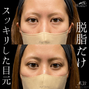 目の下の切らないたるみ取り（経結膜脱脂術）30代　女性/ 吉田Dr.