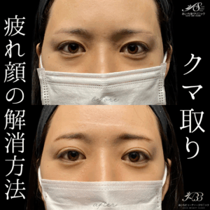 目の下の切らないたるみ取り(経結膜脱脂術)　30代　女性　/吉田Dr.