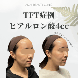 ヒアルロン酸4cc 40代女性