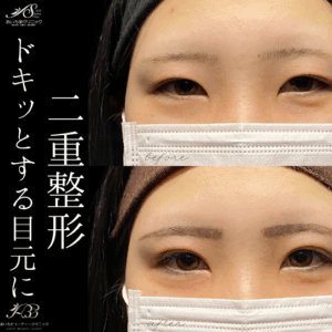 二重埋没３点法　10代　女性　/ 吉田Dr.