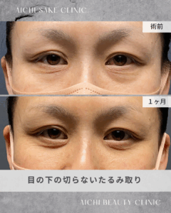 40代女性　目の下の切らないたるみ取り（経結膜脱脂術）/ 吉田Dr.