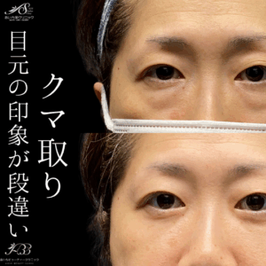 目の下の切らないたるみ取り(経結膜脱脂術)40代　女性　/吉田Dr.