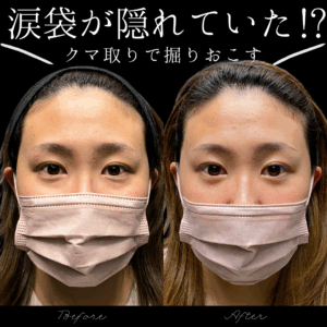 目の下の切らないたるみ取り（経結膜脱脂術）30代女性/ 吉田Dr.
