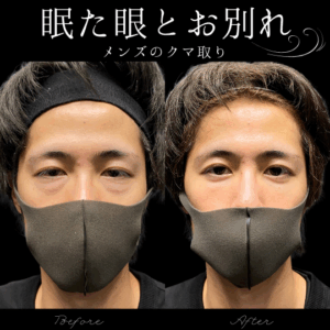 目の下の切らないたるみ取り(経結膜脱脂術)　30代　男性　/吉田Dr.