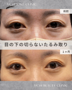 30代女性　目の下の切らないたるみ取り（経結膜脱脂術）/ 吉田Dr.