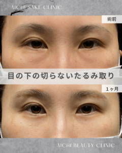 40代女性　目の下の切らないたるみ取り（経結膜脱脂術）/ 吉田Dr.