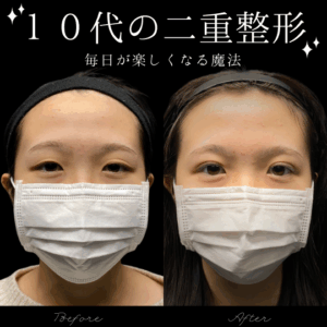自然癒着法　10代　女性　/ 吉田Dr.