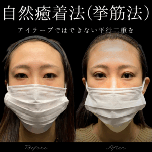 自然癒着法　20代　女性　/ 吉田Dr.