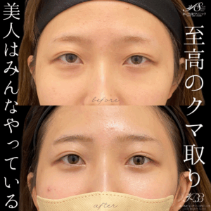 目の下の切らないたるみ取り(経結膜脱脂術)　20代　女性　/吉田Dr.