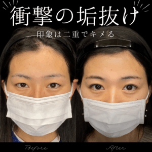 自然癒着法　20代　女性　/ 吉田Dr.