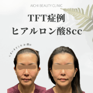 ヒアルロン酸8cc 40代女性