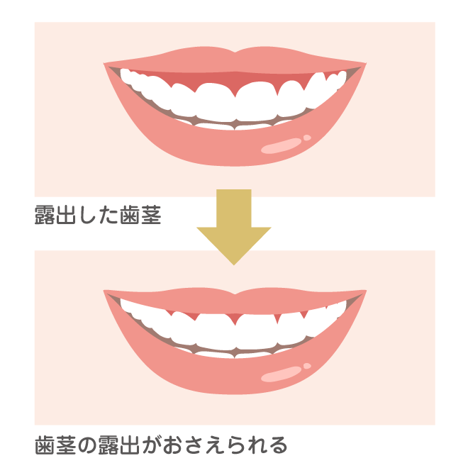 歯茎が大きく見えるガミースマイルの口元と、歯茎の露出が抑えられた状態を比較したイラスト。