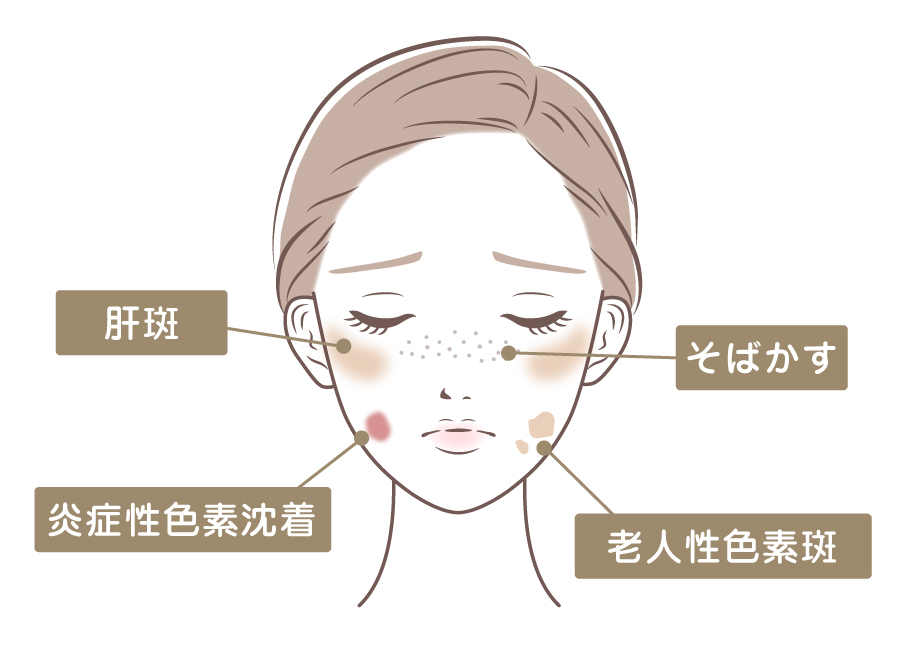 女性の顔イラストで、目の下に肝斑、鼻まわりにそばかす、頬に炎症性色素沈着、口元に老人性色素斑があることを示す解説図
