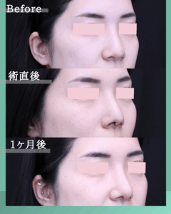２０代　鼻尖形成＋軟骨移植