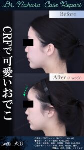 20歳代　CRFフェイス（おでこ・こめかみ）