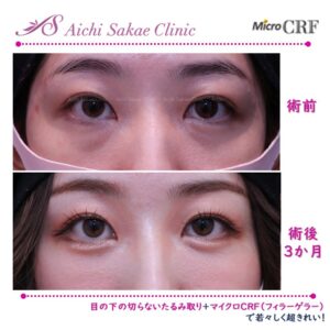 20代　目の下の切らないたるみ取り＋マイクロCRF