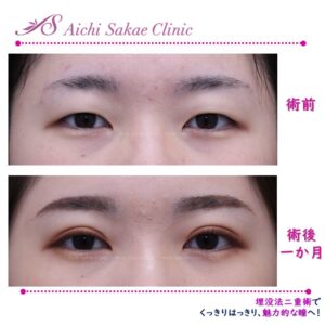20代　埋没法２点