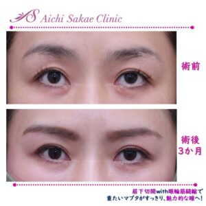 40代　眉下切開