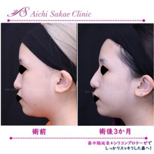 20代　シリコンプロテーゼ＋鼻中隔延長