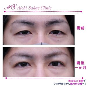 20代　メンズ埋没法２点