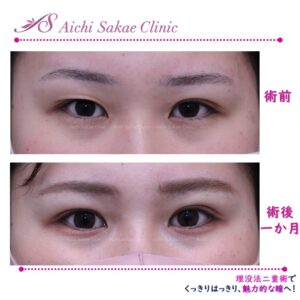 20代　埋没法２点