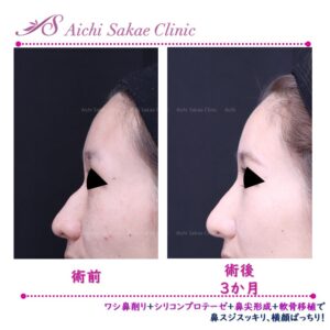 20代　シリコンプロテーゼ＋鷲鼻修正＋鼻尖形成＋軟骨移植