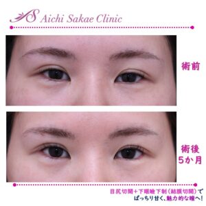20代　目尻切開＋グラマラスライン（経結膜的下眼瞼下制）